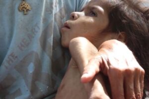 Cuarentena del COVID-19 incrementó desnutrición infantil en Venezuela