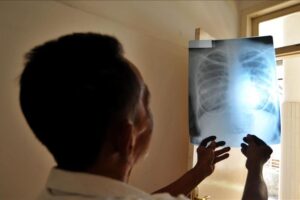 La ONG Médicos por la Salud a través del reporte Encuesta Nacional de Hospitales (ENH) difundido este jueves, dio a conocer que cerca de 46 trabajadores sanitarios del sector público venezolano se infectaron de tuberculosis entre enero y junio de 2022